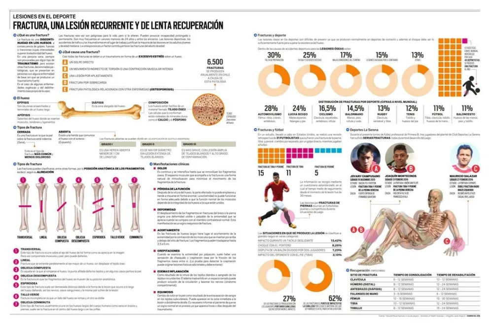 Infografía. Fracturas en el deporte
