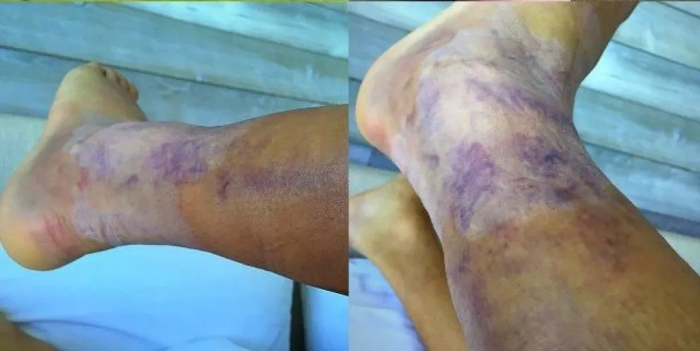 ¡Terrible! Así está el tobillo de Alexis tras criminal patada