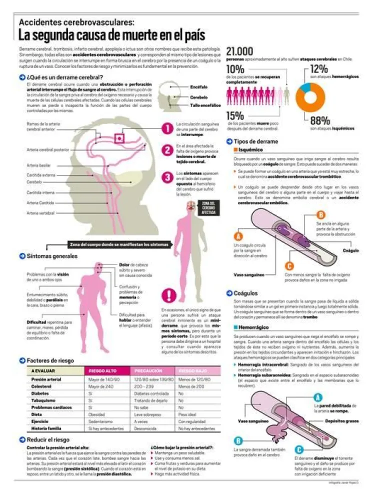 Infografía: Infarto cerebral:La segunda causa de muerte en el país