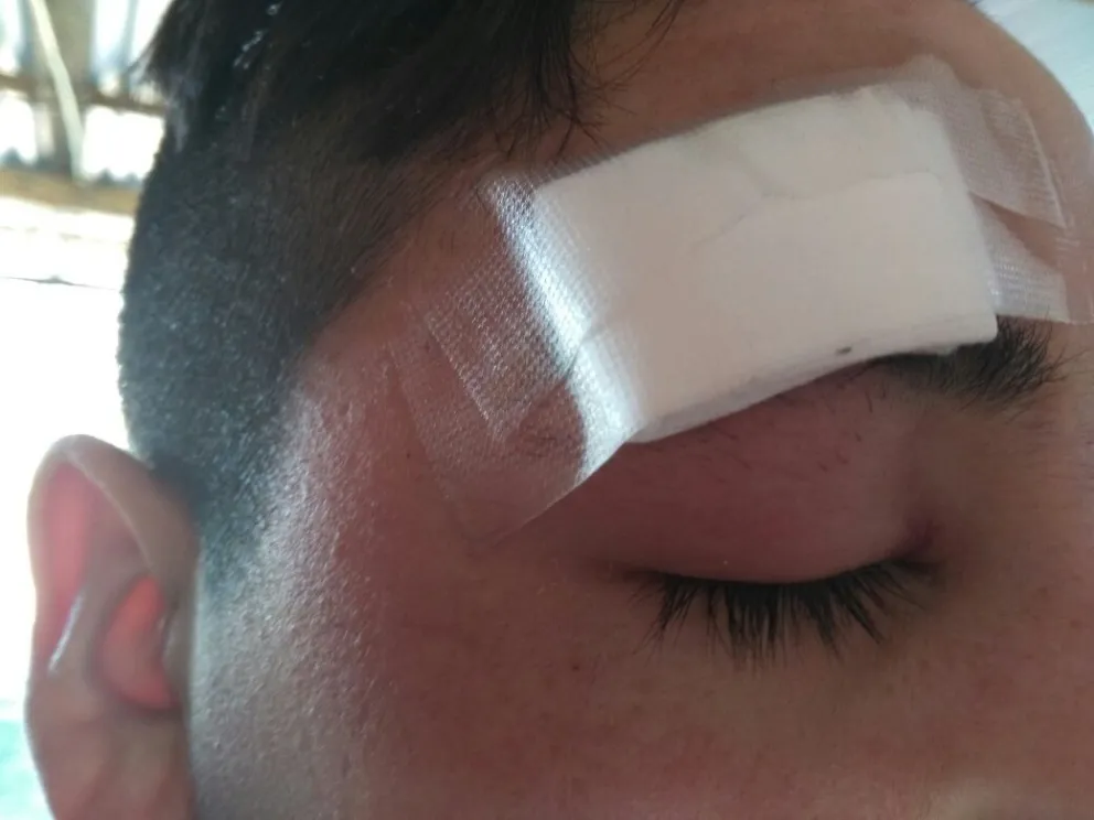En una de la cejas le tomaron cuatro puntos. Foto: Cedida