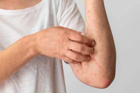 Sarampión: síntomas y prevención eficaz